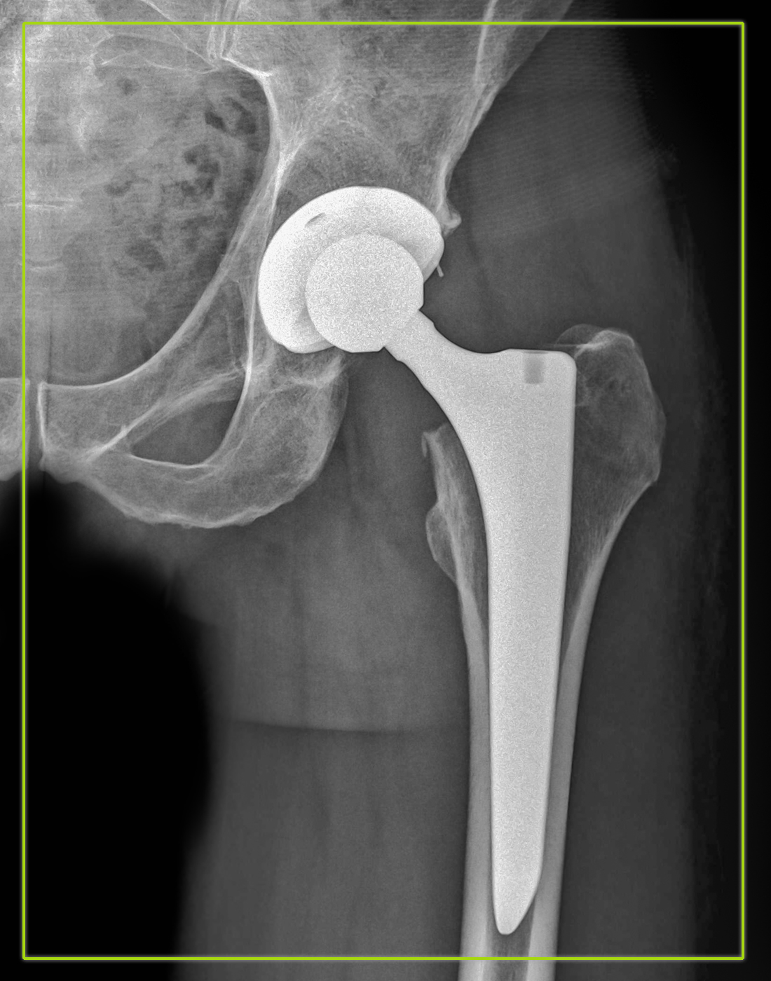 Total Joint Replacement